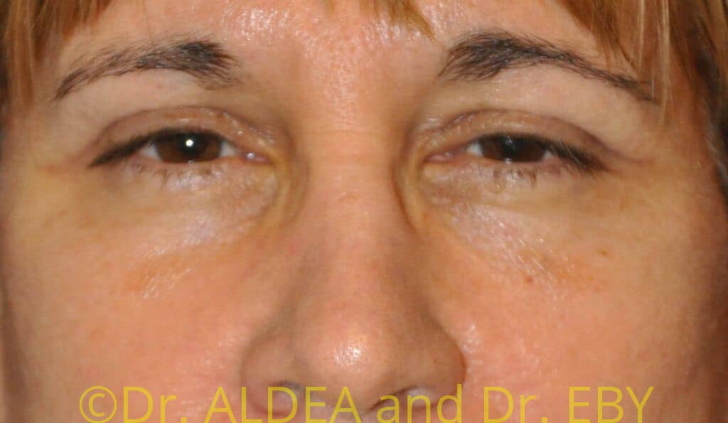 After Image: Blepharoplasty #436 - front