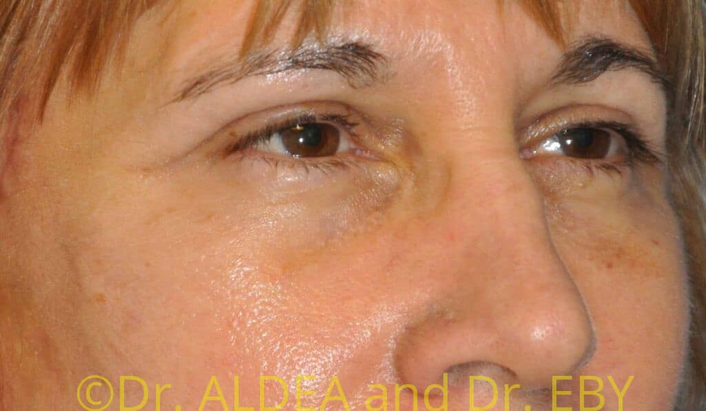 After Image: Blepharoplasty #436 - right-front-oblique