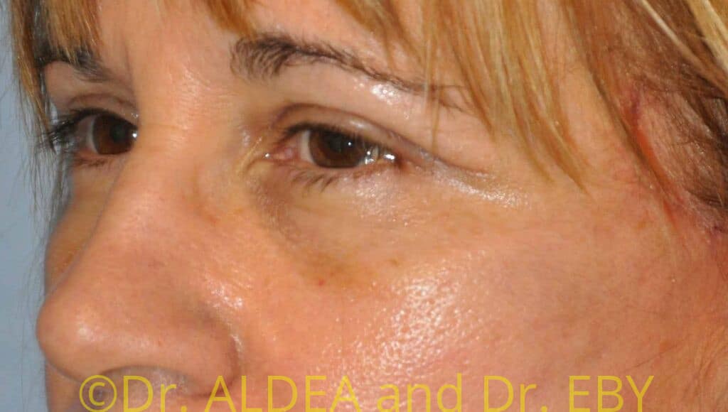 After Image: Blepharoplasty #436 - left-front-oblique