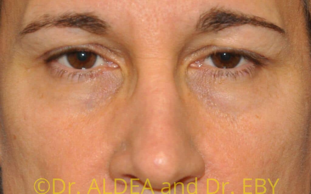 Before Image: Blepharoplasty #436 - front