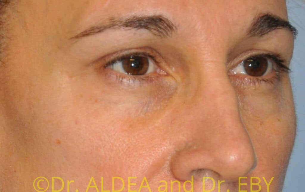 Before Image: Blepharoplasty #436 - right-front-oblique