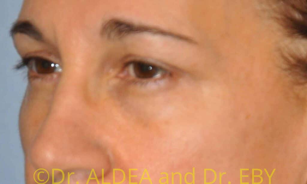 Before Image: Blepharoplasty #436 - left-front-oblique