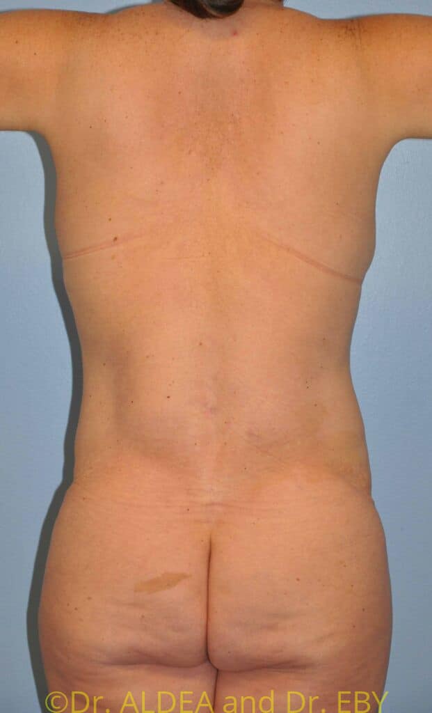 After Image: Back Scoop Liposuction #638 - back