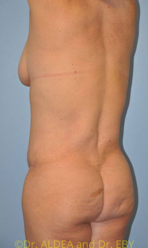 After Image: Back Scoop Liposuction #638 - left-back-oblique