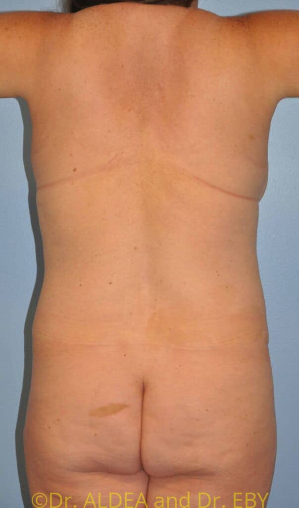 Before Image: Back Scoop Liposuction #638 - back