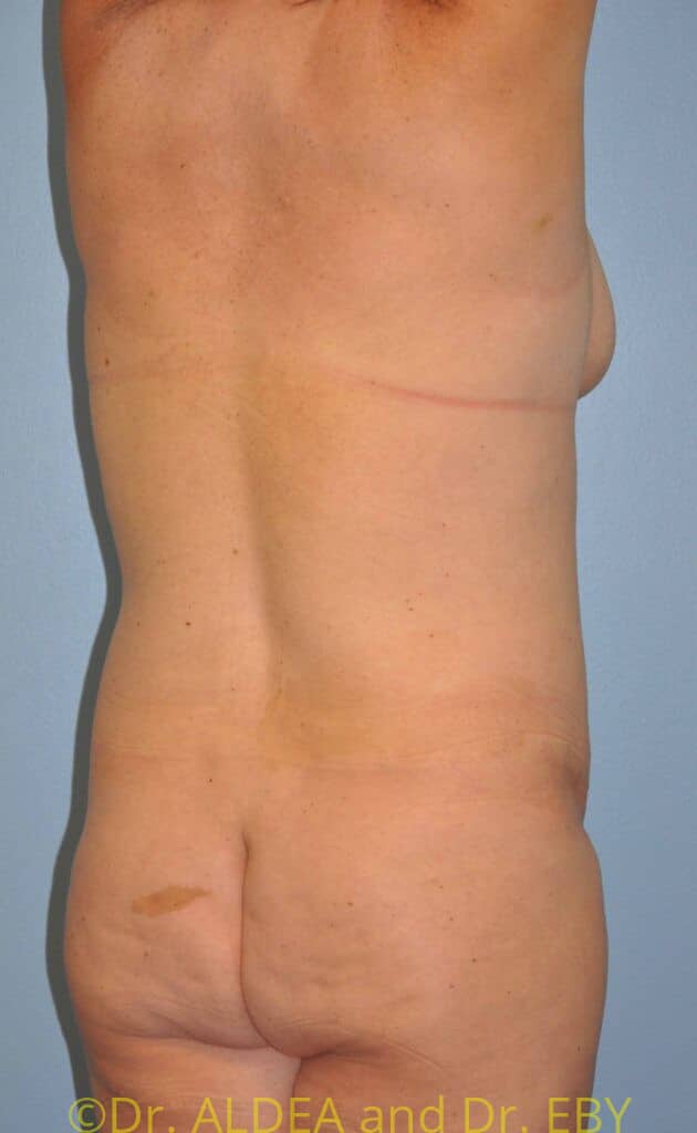 Before Image: Back Scoop Liposuction #638 - right-back-oblique
