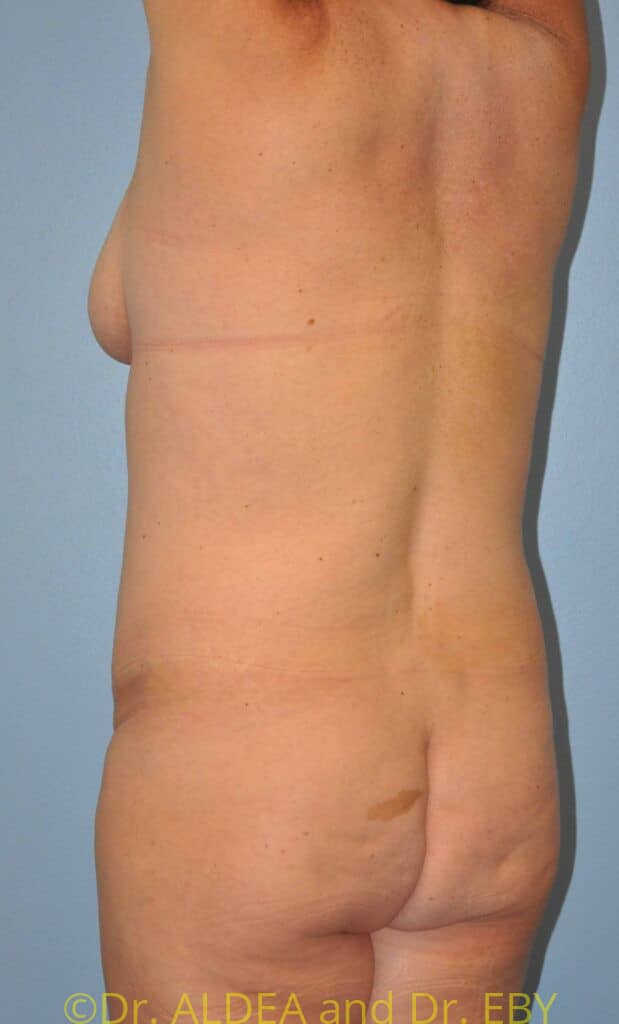 Before Image: Back Scoop Liposuction #638 - left-back-oblique