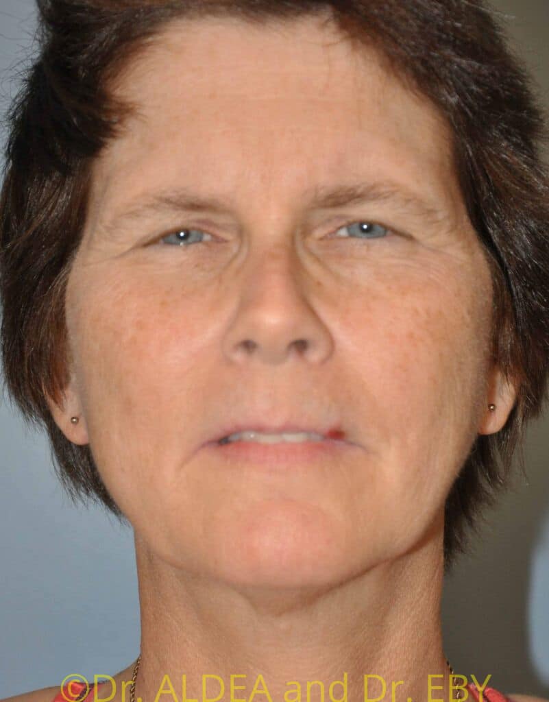 Before Image: Facelift #515 - front