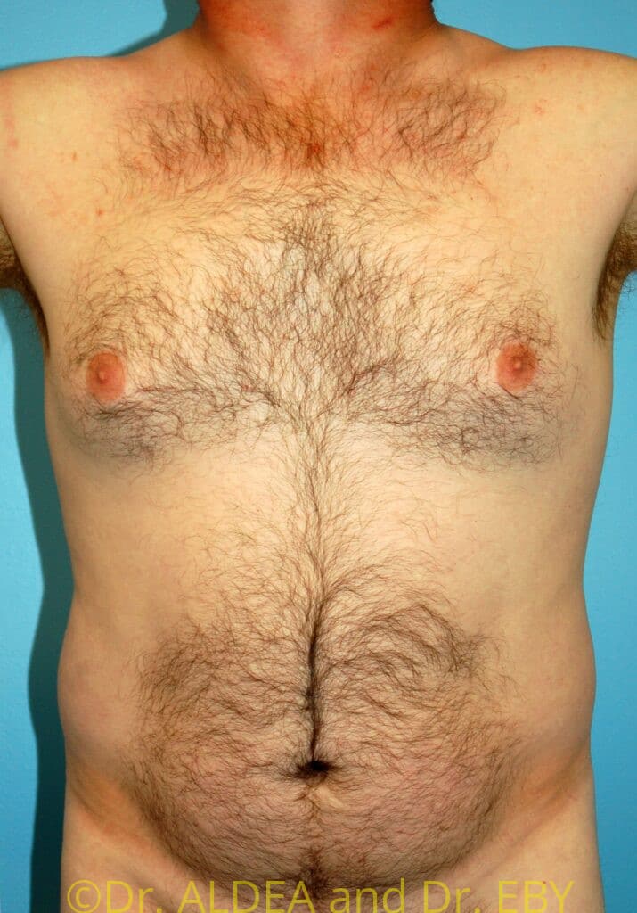 Before Image: Gynecomastia #832 - front