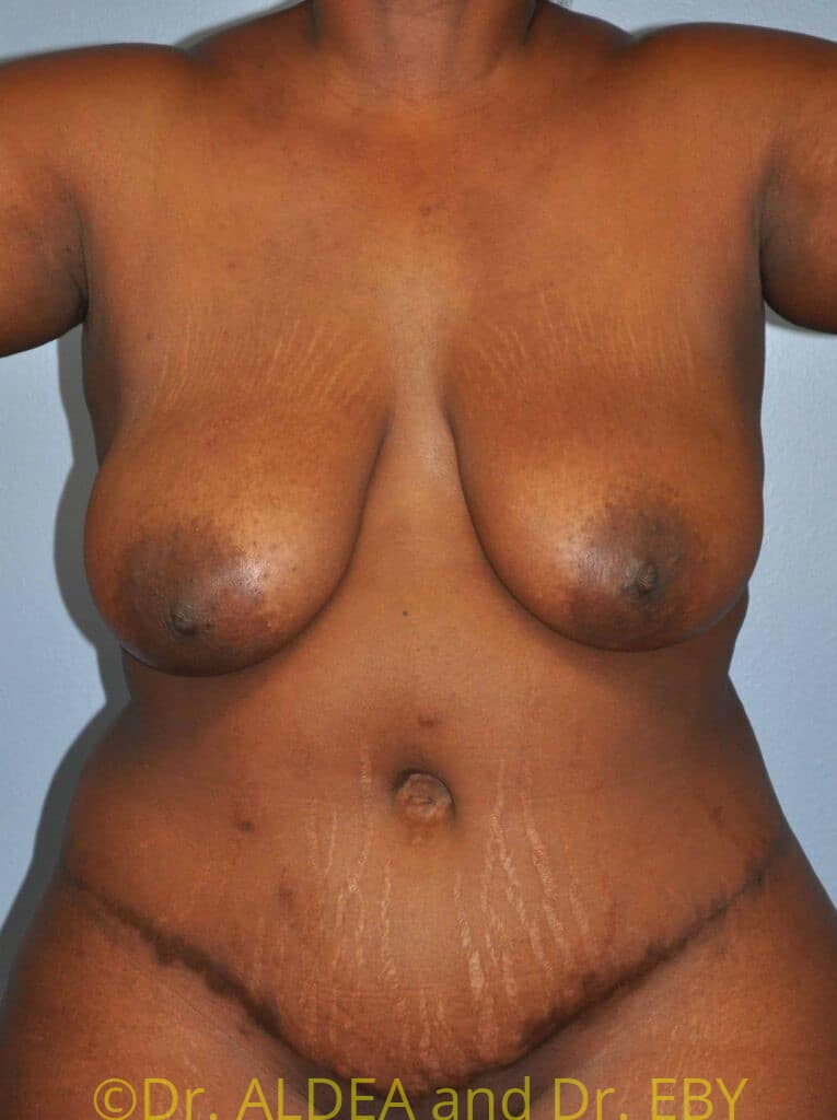 Before Image: Liposuction #631 - front