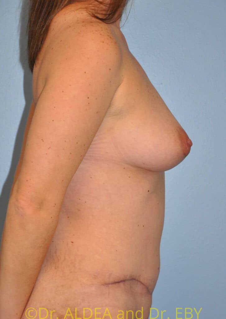 After Image: Mommy Makeover #272 - right-side