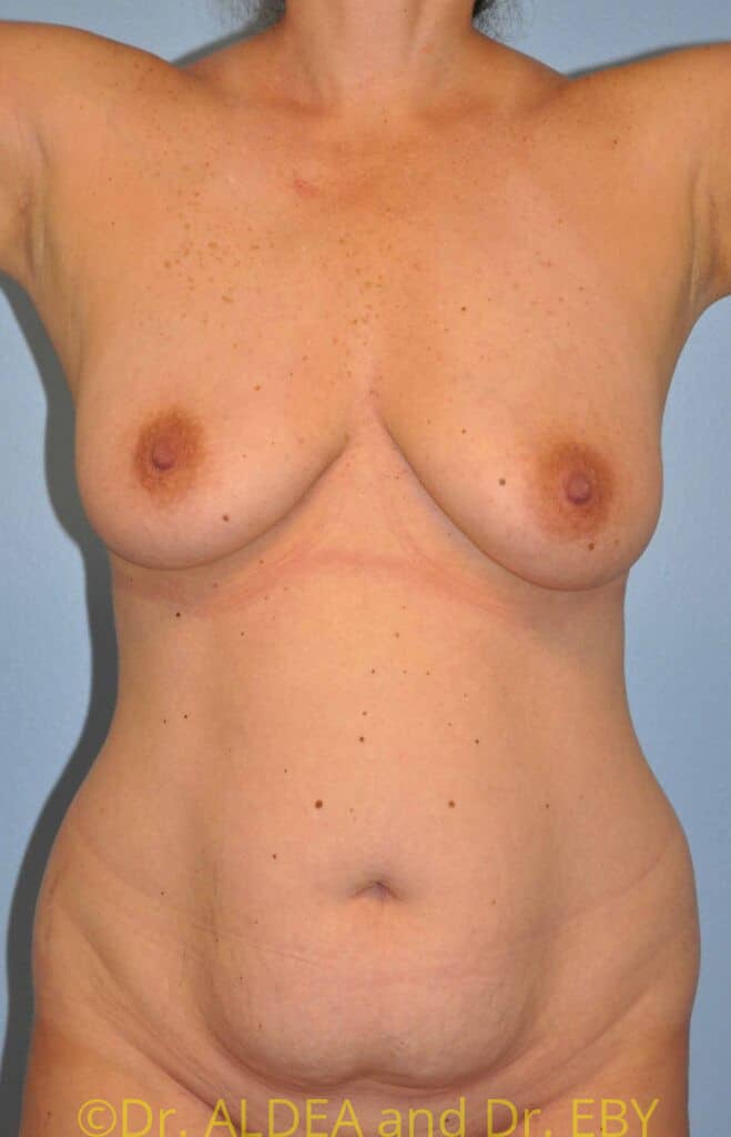 Before Image: Mommy Makeover #272 - front
