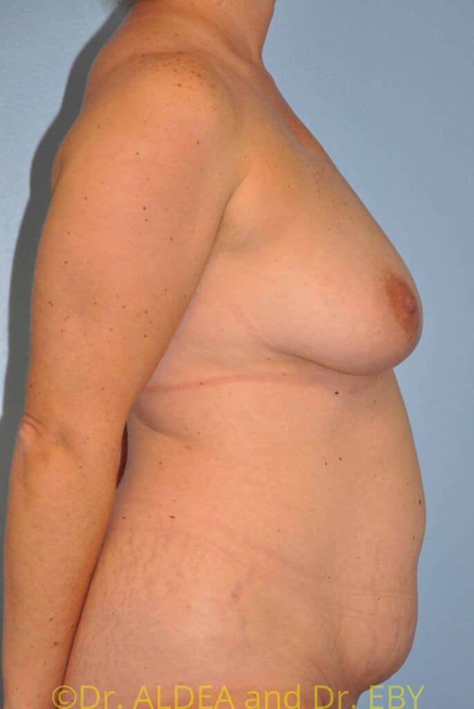 Before Image: Mommy Makeover #272 - right-side