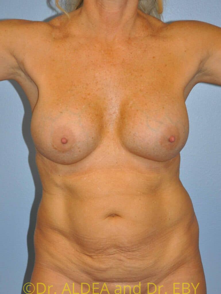 Before Image: Tummy Tuck #367 - front