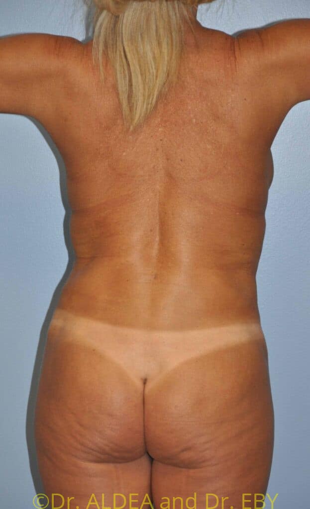 After Image: Tummy Tuck #367 - back