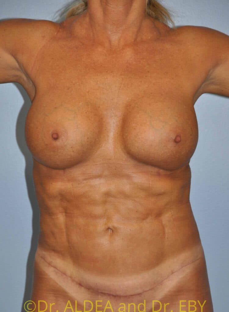 After Image: Tummy Tuck #367 - front