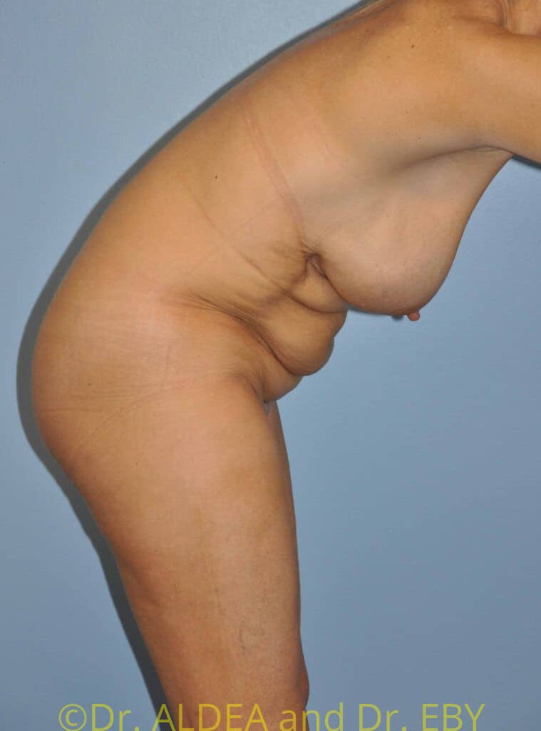 Before Image: Tummy Tuck #367 - other