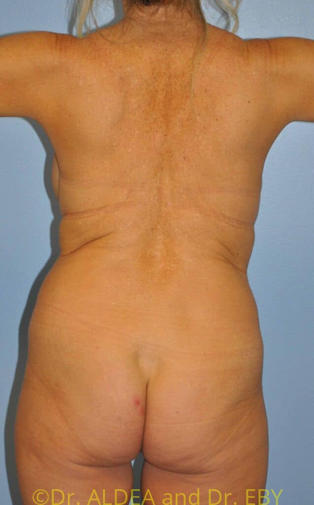 Before Image: Tummy Tuck #367 - back