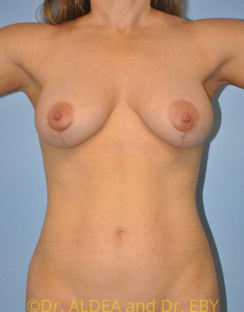 Before Image: Breast Augmentation w/ Lift #947 - front