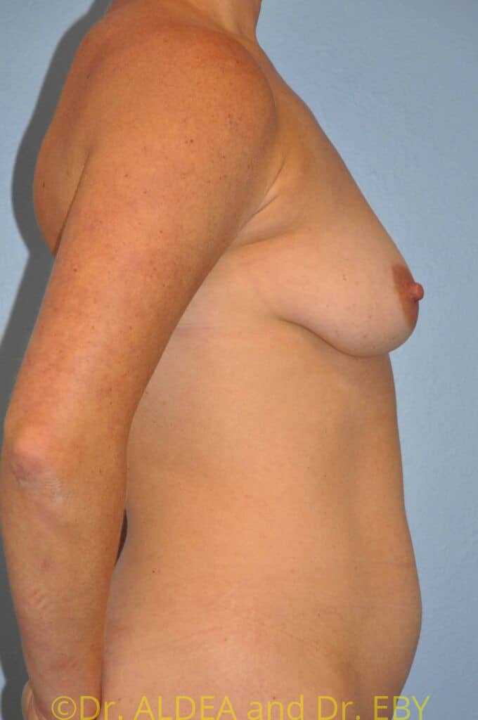 Before Image: Breast Augmentation w/ Lift #658 - right-side