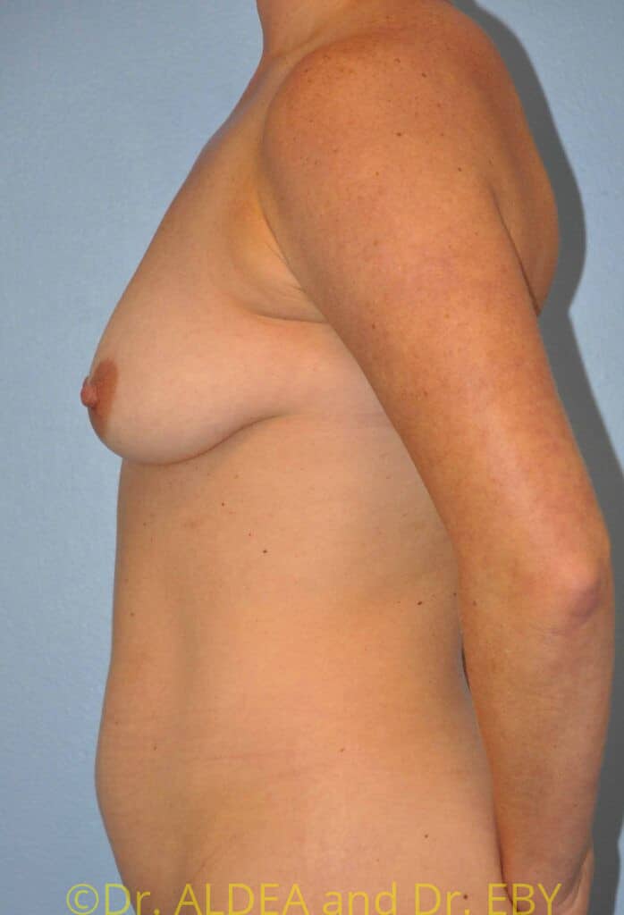 Before Image: Breast Augmentation w/ Lift #658 - left-side