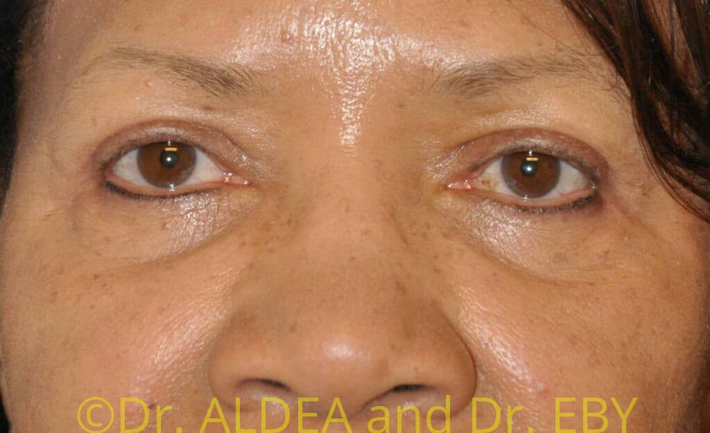 After Image: Blepharoplasty #469 - front