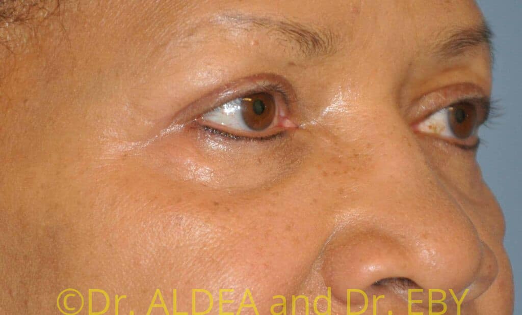 After Image: Blepharoplasty #469 - right-front-oblique