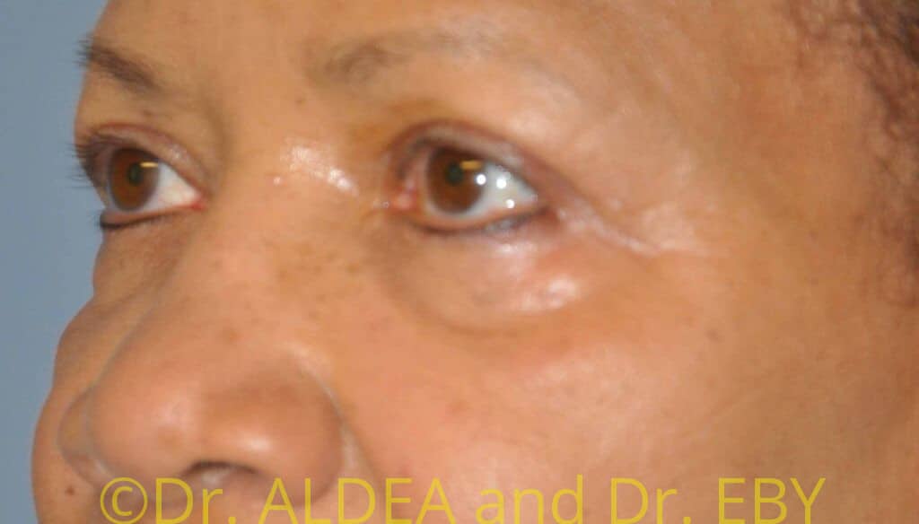 After Image: Blepharoplasty #469 - left-front-oblique