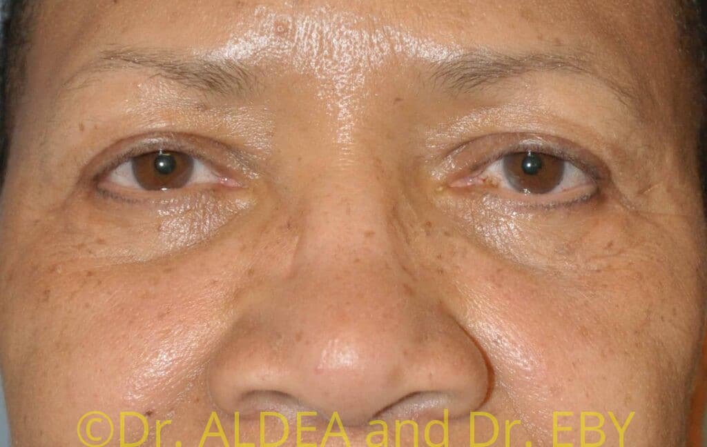 Before Image: Blepharoplasty #469 - front