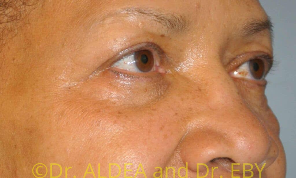 Before Image: Blepharoplasty #469 - right-front-oblique