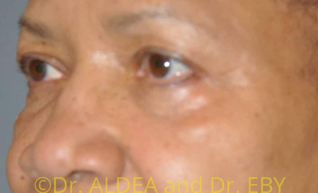 Before Image: Blepharoplasty #469 - left-front-oblique