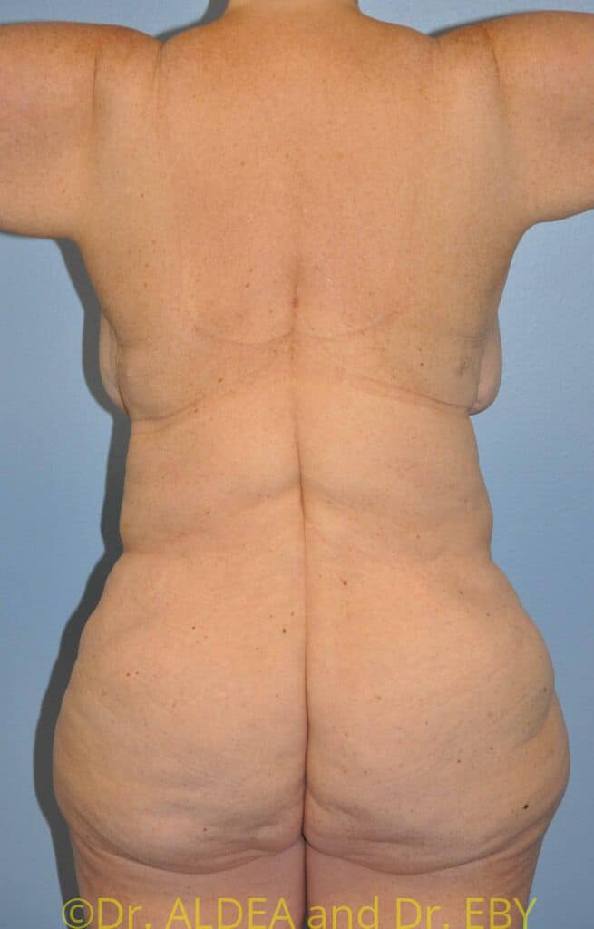 After Image: Back Scoop Liposuction #837 - back