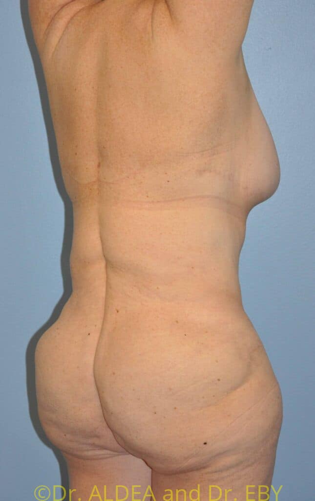 After Image: Back Scoop Liposuction #837 - right-back-oblique