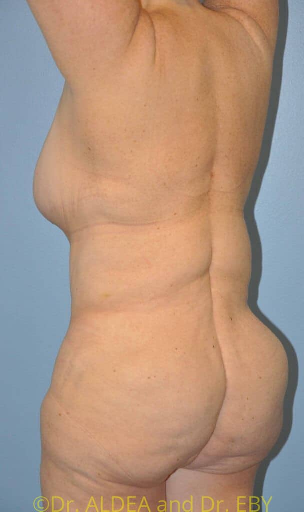 After Image: Back Scoop Liposuction #837 - left-back-oblique