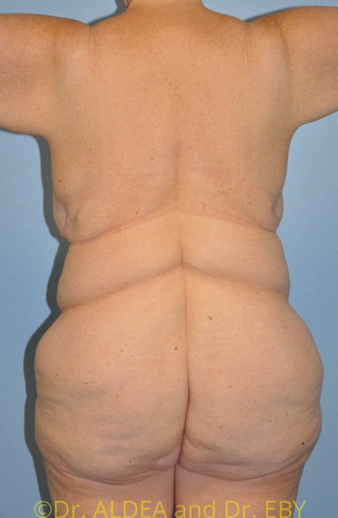 Before Image: Back Scoop Liposuction #837 - back