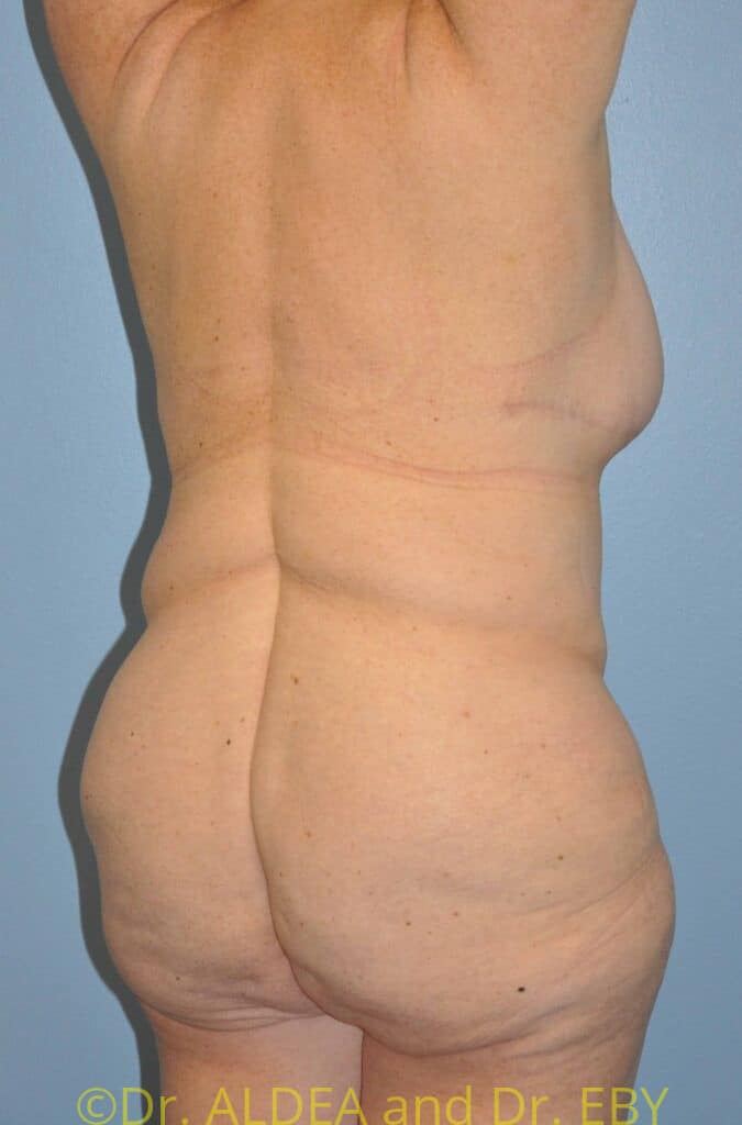 Before Image: Back Scoop Liposuction #837 - right-back-oblique