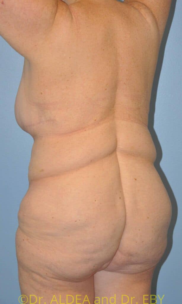 Before Image: Back Scoop Liposuction #837 - left-back-oblique