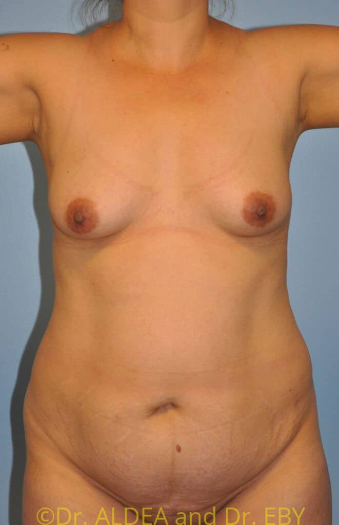 Before Image: Tummy Tuck #949 - front