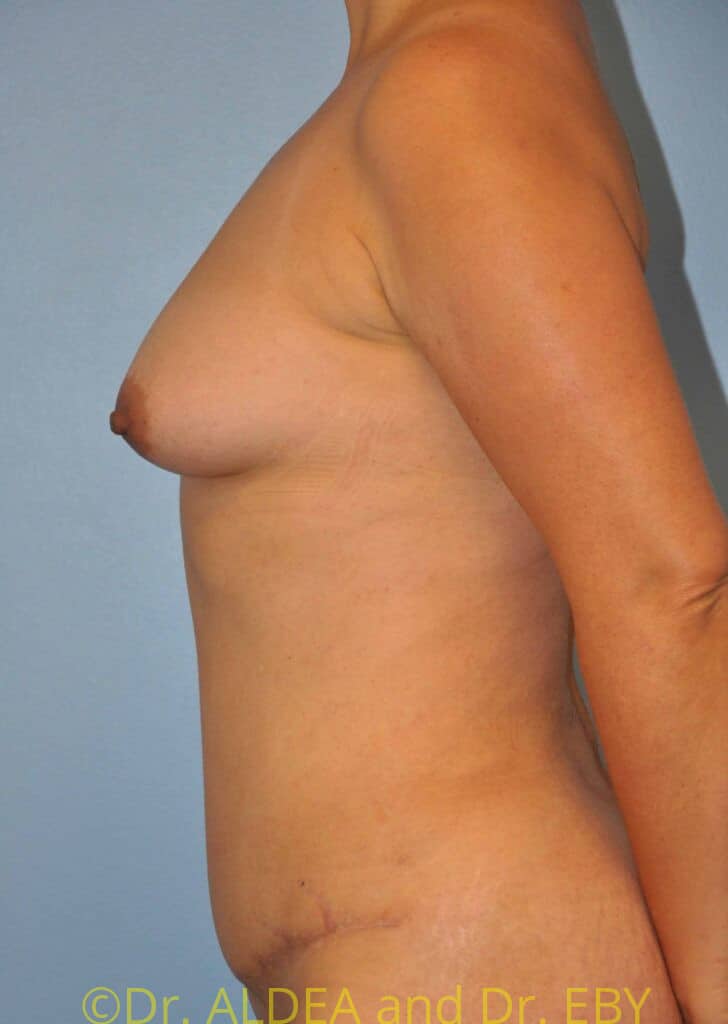 After Image: Tummy Tuck #949 - left-side