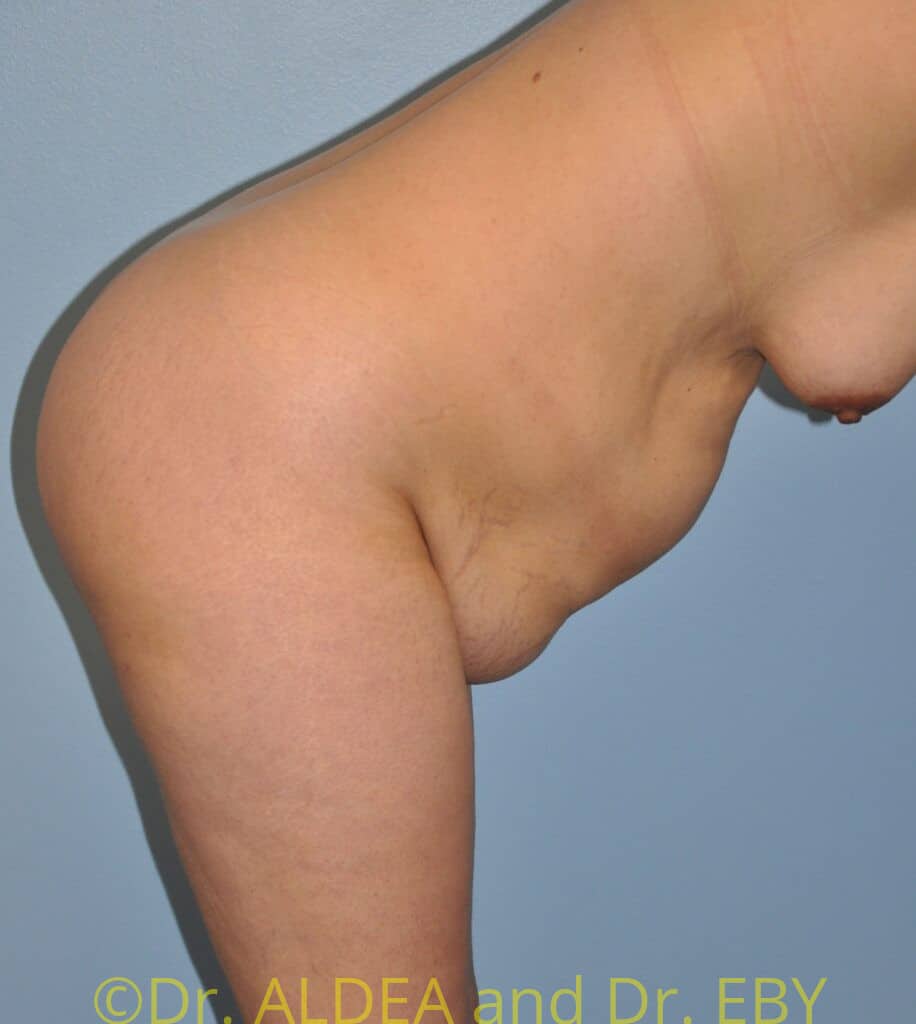 Before Image: Tummy Tuck #949 - other