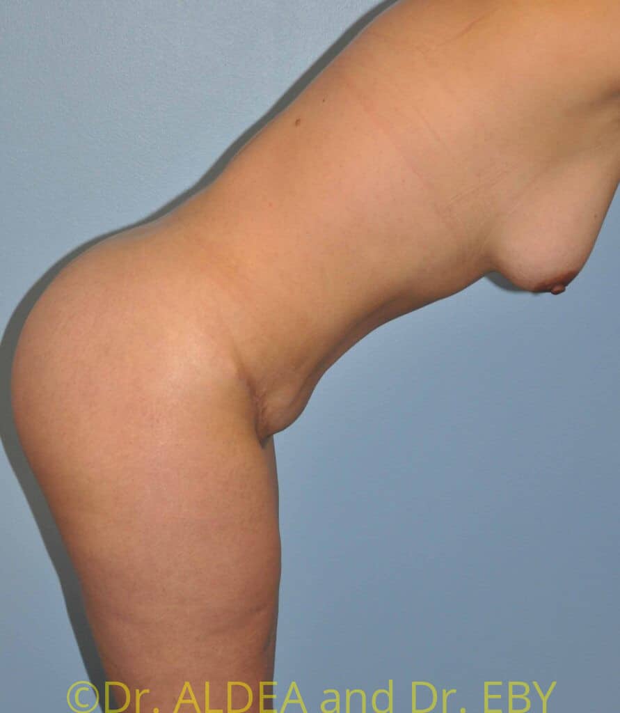 After Image: Tummy Tuck #949 - other