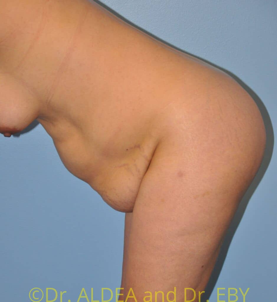 Before Image: Tummy Tuck #949 - other
