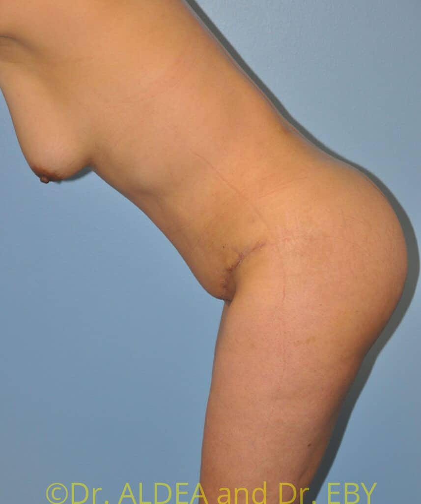 After Image: Tummy Tuck #949 - other