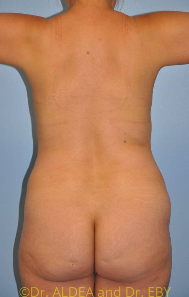 Before Image: Tummy Tuck #949 - back