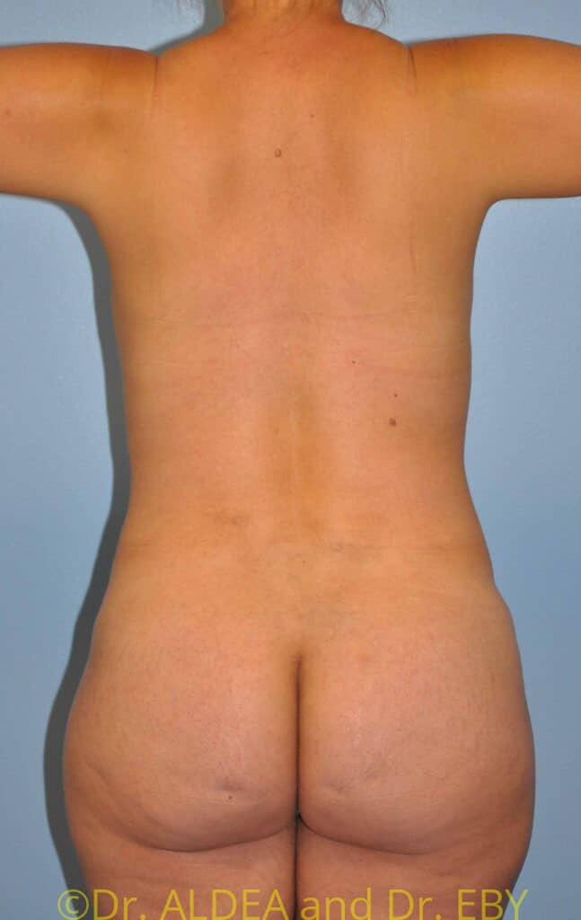 After Image: Tummy Tuck #949 - back
