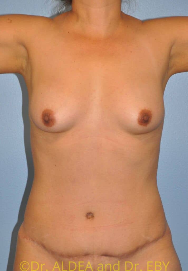 After Image: Tummy Tuck #949 - front