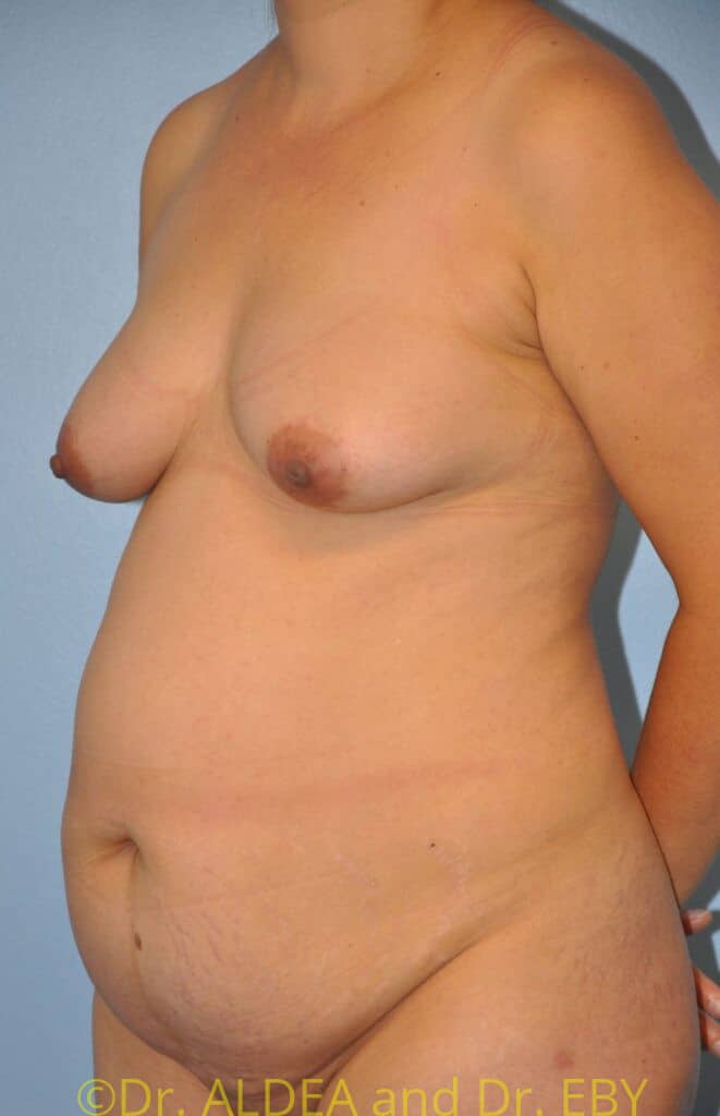 Before Image: Tummy Tuck #949 - left-front-oblique