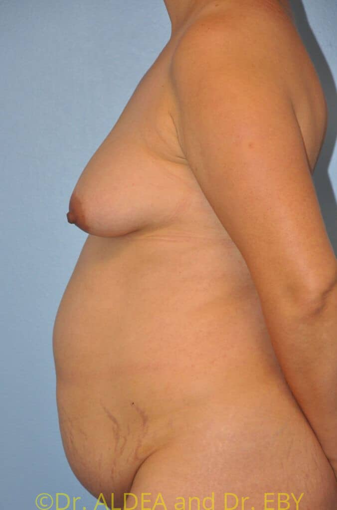 Before Image: Tummy Tuck #949 - left-side
