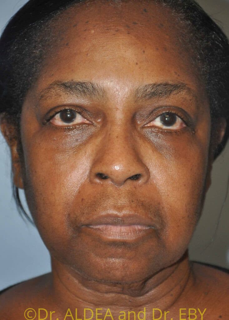 Before Image: Facelift #658 - front