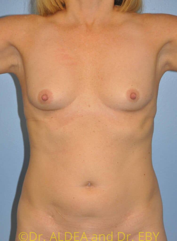 Before Image: Liposuction #784 - front